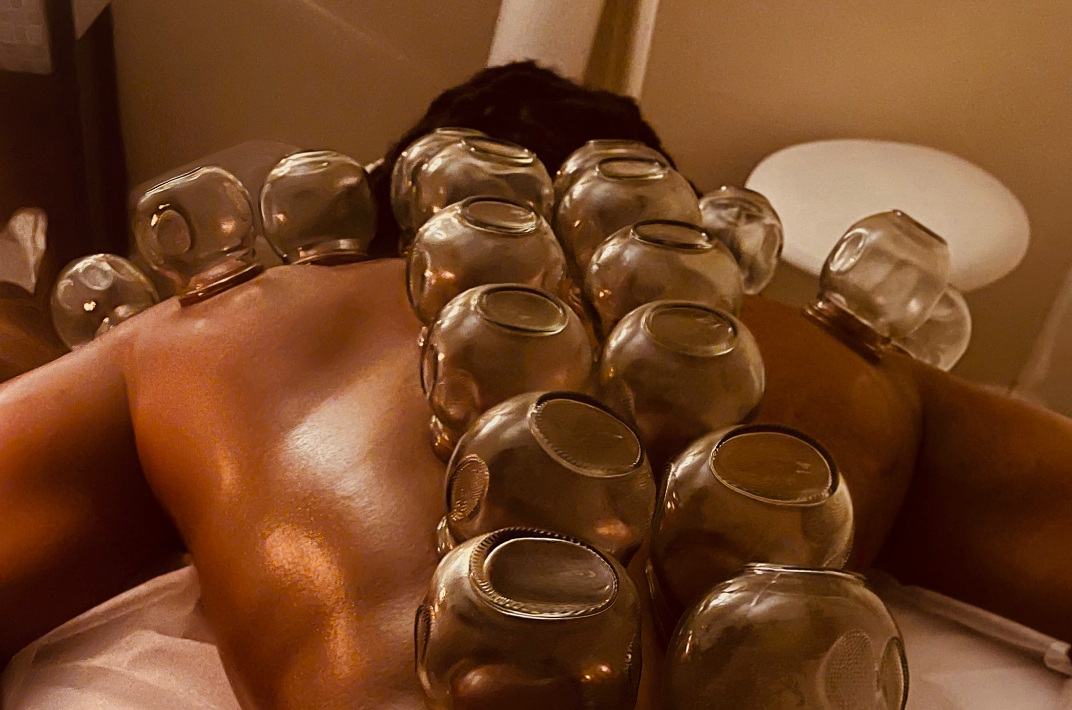 Fire Cupping Therapy at Thai Aroma Bodywork